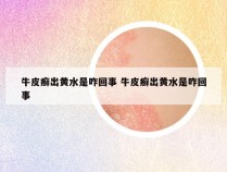 牛皮癣出黄水是咋回事 牛皮癣出黄水是咋回事