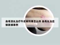 血毒清丸治疗牛皮癣效果怎么样 血毒丸治愈银屑病事例