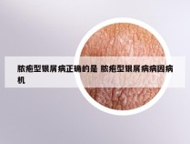 脓疱型银屑病正确的是 脓疱型银屑病病因病机