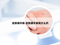 皮肤病手癣 皮肤病手癣用什么药