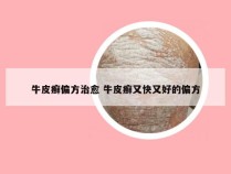 牛皮癣偏方治愈 牛皮癣又快又好的偏方