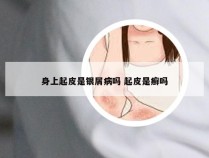 身上起皮是银屑病吗 起皮是癣吗