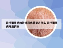 治疗银屑病的外抹药水是复方什么 治疗银屑病外用药物