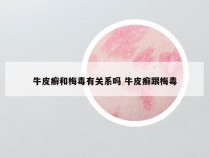 牛皮癣和梅毒有关系吗 牛皮癣跟梅毒