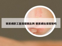 银屑病职工医保报销比例 银屑病社保报销吗