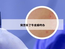 突然长了牛皮癣咋办