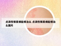 点滴性银屑病能根治么 点滴性银屑病能根治么图片