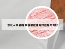 东北人银屑病 银屑病在北方好还是南方好