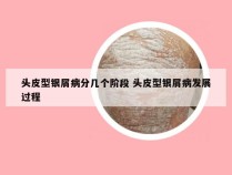 头皮型银屑病分几个阶段 头皮型银屑病发展过程