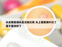 头皮银屑病头皮没有红斑 头上银屑病不红了是不是快好了