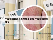 牛皮癣治好最长多少年不复发 牛皮癣治愈率多少