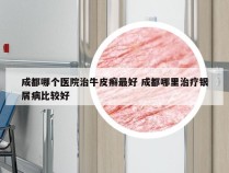 成都哪个医院治牛皮癣最好 成都哪里治疗银屑病比较好