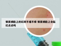 银屑病脸上的红斑不痛不痒 银屑病脸上会起红点点吗