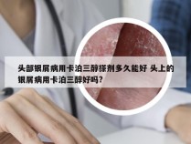 头部银屑病用卡泊三醇搽剂多久能好 头上的银屑病用卡泊三醇好吗?