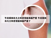 牛皮癣抹白凡士林感觉越来越严重 牛皮癣抹白凡士林感觉越来越严重了