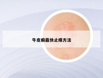 牛皮癣最快止痒方法