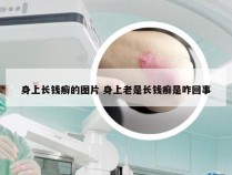 身上长钱癣的图片 身上老是长钱癣是咋回事