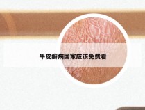 牛皮癣病国家应该免费看