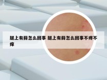 腿上有藓怎么回事 腿上有藓怎么回事不疼不痒