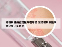 潍坊银屑病正规医院在哪里 潍坊银屑病医院是公立还是私立