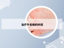 治疗牛皮癣的妙招