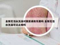 金银花泡水洗澡对银屑病有效果吗 金银花泡水洗澡可以止痒吗