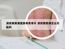 滴状银屑病查肤毒有用不 滴状银屑病怎么引起的