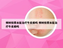 柳树枝煮水能治疗牛皮癣吗 柳树枝煮水能治疗牛皮癣吗