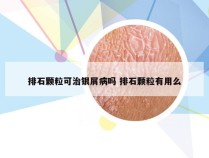 排石颗粒可治银屑病吗 排石颗粒有用么