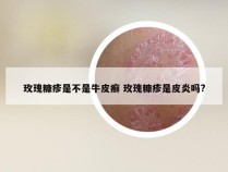 玫瑰糠疹是不是牛皮癣 玫瑰糠疹是皮炎吗?