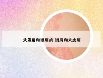 头发屑和银屑病 银屑和头皮屑