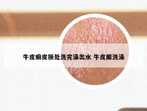 牛皮癣皮损处洗完澡出水 牛皮廨洗澡