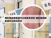 哺乳期有银屑病可以用肤毒清吗 哺乳期间银屑病可以擦的药膏