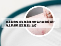 身上长癣反反复复发作用什么药膏治疗最好 身上长癣反反复复怎么治疗