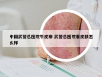 中国武警总医院牛皮癣 武警总医院看皮肤怎么样