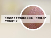 怀孕两边长牛皮癣是怎么回事 一怀孕身上的牛皮癣就好了