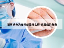 银屑病分为几种都是什么样 银屑病的分类