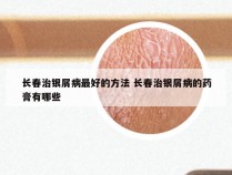 长春治银屑病最好的方法 长春治银屑病的药膏有哪些