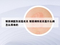 银屑病医生说是皮炎 银屑病样皮炎是什么病怎么得来的