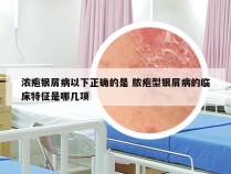 浓疱银屑病以下正确的是 脓疱型银屑病的临床特征是哪几项