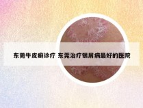 东菀牛皮癣诊疗 东莞治疗银屑病最好的医院