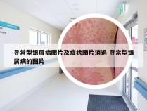 寻常型银屑病图片及症状图片消退 寻常型银屑病的图片