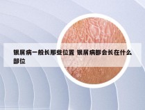 银屑病一般长那些位置 银屑病都会长在什么部位