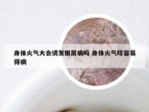 身体火气大会诱发银屑病吗 身体火气旺容易得病