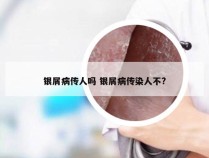 银屑病传人吗 银屑病传染人不?