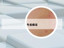牛皮癣证