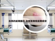 白斑的前期图片 白斑有哪些前期症状