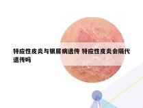 特应性皮炎与银屑病遗传 特应性皮炎会隔代遗传吗