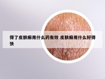 得了皮肤癣用什么药有效 皮肤癣用什么好得快