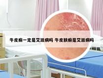 牛皮癣一定是艾滋病吗 牛皮肤癣是艾滋病吗